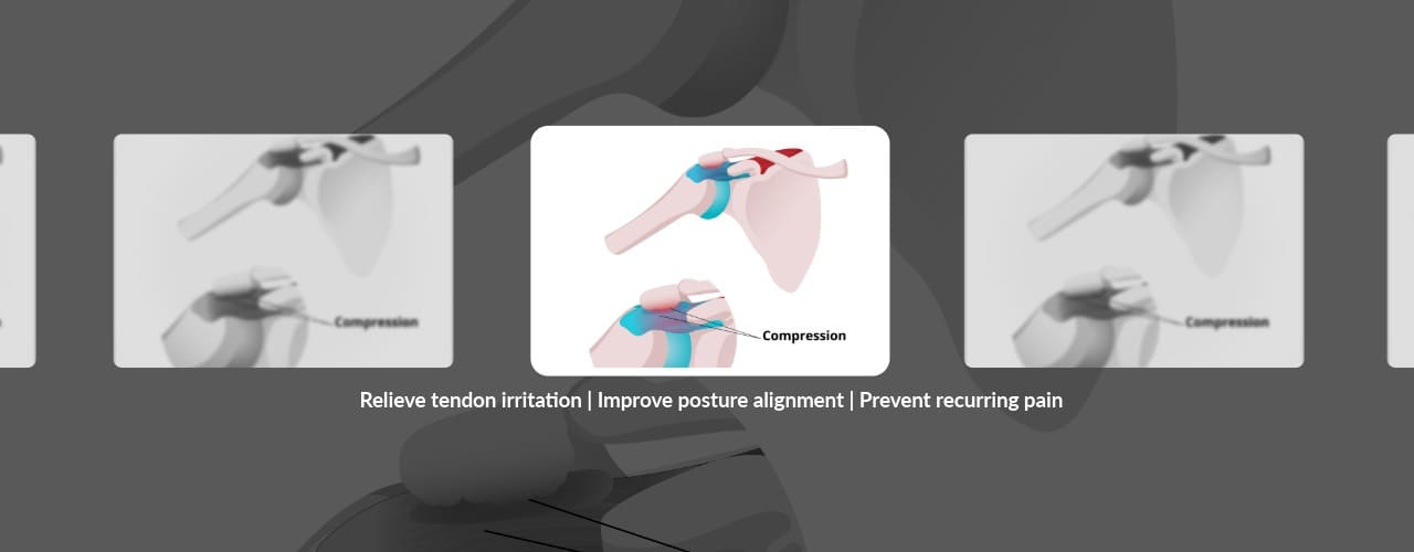 Understanding Shoulder Impingement Syndrome