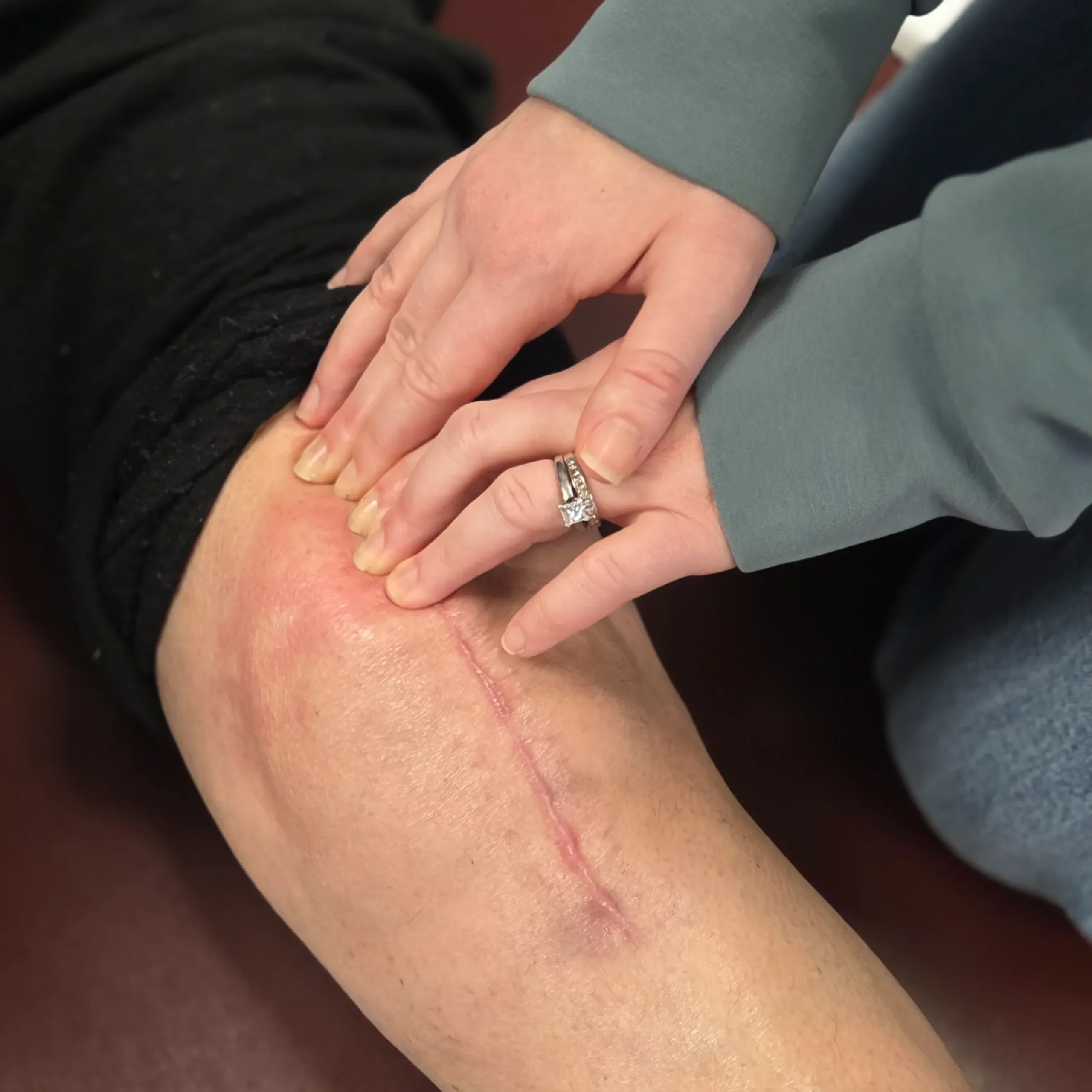 physical therapist examining knee after knee surgery